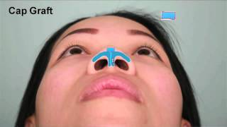 Asian Rhinoplasty Tip Augmentation Case Study Part 2  Dr Thomas Buonassisi 8 West Clinic in BC [upl. by Yrreb174]