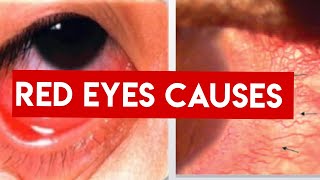 RED EYE  CAUSES  Conjunctivitis Vs Uveitis vs Acute angle closure Glaucoma [upl. by Senga538]