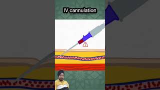 Procedure for Intravenous canula animation medicalanimation cannulation education doctor [upl. by Kirtley]