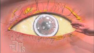 Cholesterol Deposits in the Eye The Doctors [upl. by Tierell360]