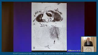 Primary Spinal Syringomyelia  Dr Ulrich Batzdorf  ASAPs 2023 Conference [upl. by Mulford]