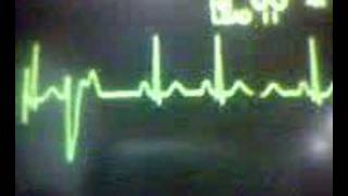 ECG Video Ectopics  Ventricular unifocal [upl. by Ydasahc]