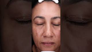 A demonstration of the mesoestetic® mesopeel® melanostop tran3x with Luxe Skin Aesthetics UnboxMe [upl. by Najib2]