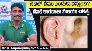 వినికిడి సమస్యకు చెవిలో చీము రావడం కారణమా  Reasons for Pus in the Ear  Socialpost Health [upl. by Rand]