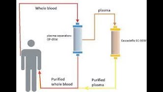 DFPP double filtration Plasmapheresis [upl. by Euqinimod]