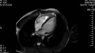 Cardiología HU  Resonancia Magnética Cardiaca Normal [upl. by Latnahc]