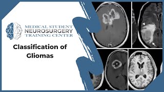 Classification of Gliomas [upl. by Etyak369]