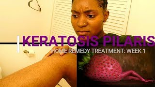 HOW TO REMOVE KERATOSIS PILARIS Week 1 Home Remedy Treatment [upl. by Arabel4]