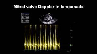 Echocardiography Essentials Detecting pericardial effusions [upl. by Ajed]