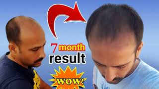 neo hair lotion 7 month result😱 neo hair lotion 7 month reviews [upl. by Elorac]