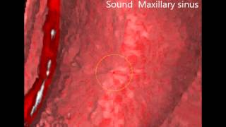 CBCT Maxillary sinus Chronic Maxillary Sinusitis [upl. by Ydnil66]