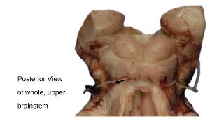 LTB Learning the brainstem video 7 Rostral pons part one edited [upl. by Airotna]