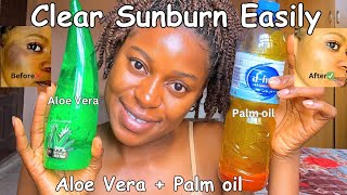 The most effective SUNBURN remedy in the World💯 How to clear sunburn amp facial redness [upl. by Nohcim498]