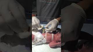 Cutting the navicular of a newborn baby sumitnicunursingstm youtubeshorts nursing newbornbaby [upl. by Sumer]