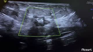 Breast cancer malignant mass ultrasound biopsy proved BIRDAS 6 sonography ARDMS [upl. by Survance877]