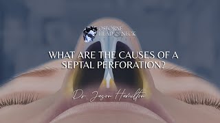 What are the causes of a septal perforation [upl. by Fowler]