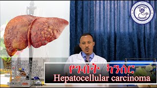 የጉበት ካንሰር ምንነት እና መፍትሄዎቹ Hepatocellular carcinoma and Its management [upl. by Nnylidnarb314]