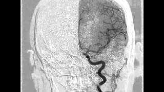 Cerebral aneurisme angiogram [upl. by Oivaf963]