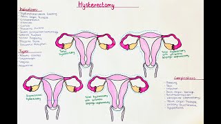 Hysterectomy  Indications Types Procedure Complications [upl. by Binnings592]