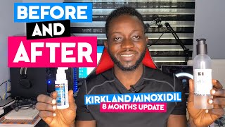 Minoxidil Before and After 8 Months Minoxidil Update [upl. by Gnagflow]