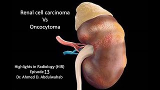 Renal Cell Carcinoma vs Oncocytoma Highlights in Radiology Episode 13 [upl. by Ivey668]