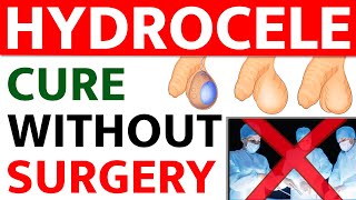 Hydrocele Cure Without Surgery  Hydrocele Causes Symptoms and Treatment  Bharat Homeopathy [upl. by Ahsiekin592]