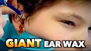 GIANT EAR WAX REMOVAL  Dr Paul [upl. by Nwonknu]