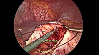 Laparoscopic cystogastrostomy [upl. by Bettye]