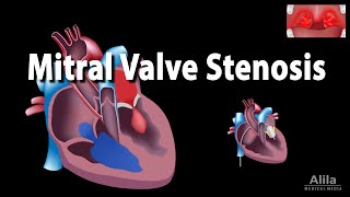 Mitral Valve Stenosis Animation [upl. by Attener]