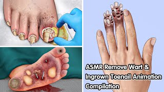 ASMR Remove Wart amp Ingrown Toenail Animation Compilation  Deep Cleaning Animation [upl. by Nosauq454]