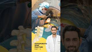 Treatment of Osteoporotic spine fracture  Dr Dheeraj Batheja  Artemis Hospital doctor spine [upl. by Hanselka]