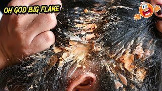 Psoriasis Huge Flakes  Huge Dandruff Flakes Scratching On Scalp Hair Care [upl. by Sanfourd]