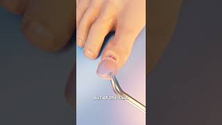 How Toenail Removal Works 😳 [upl. by Irrep950]