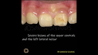 Enamel Hypoplasia Management [upl. by Parrisch172]