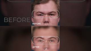 Transformative Upper Eyelid Lift Discover Dr David Stokers Secrets [upl. by Nogas]