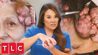 Dr Lee Removes Gigantic CauliflowerLike Bumps on Patients Head  Dr Pimple Popper [upl. by Eibmab]