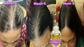 Update How My Mom Regrow Lost Hair  Rosemary Essential Oil Hair Regrowth Before After Shinny Roops [upl. by Lsil381]