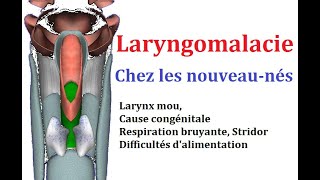 Laryngomalacie stridor chez le bébé anatomie de larynx mou [upl. by Lugar]