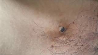 LATEST Blackheads Comedones  EXTRACTION 25 DECEMBER 2017 [upl. by Noman238]