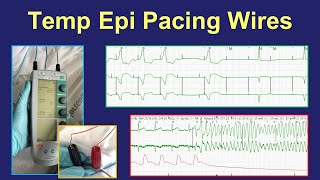 Surgical epicardial pacing wires  uses and management [upl. by Nais]