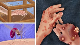 ASMR The best treatment vs removal of insect bites blisters on the hands of scientists  돌보는 애니메이션 [upl. by Rehportsirhc]