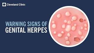 5 Warning Signs of Genital Herpes [upl. by Gilchrist437]