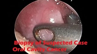 Endoscopic Biopsy of Suspected Case of Oral Cavity Cancer Under LA  SCC [upl. by Hilar]