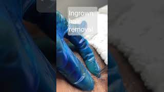 Ingrown Hair Removal [upl. by Airbas]