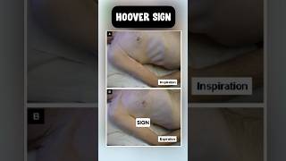 Hoover sign in copd usmle neetpg pulmonology [upl. by Jammal]