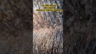 Lice removalhow to treat lice from hairhow to prevent from licelice removal in parlourbangalore [upl. by Rol]