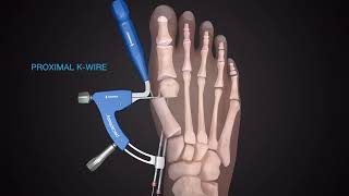 MinimallyInvasive Bunion Correction Surgery [upl. by Enhpad]