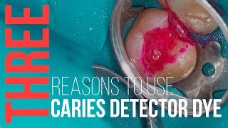 3 Reasons to Use Caries Detector Dye [upl. by Matthiew]