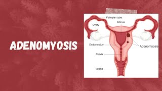 Adenomyosis Causes Symptoms Diagnosis amp Treatment  Comprehensive Guide [upl. by Aihseuqram520]