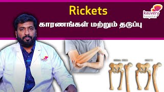 Rickets  Causes amp Prevention  Tamil [upl. by Icken]